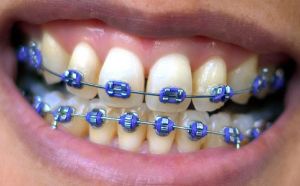 Braces_smile_purple