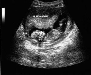 Sonogram-1