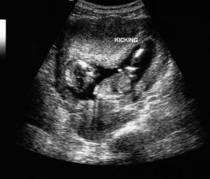 Sonogram-2
